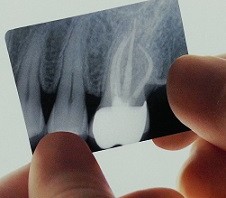 root canal